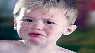 إصابة 36 تلميذا بالجديري المائي بالأقصر