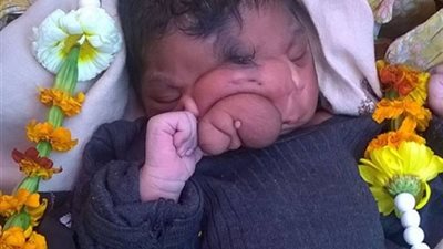 بالصور .. ولادة نادرة لطفلة بوجه فيل في الهند