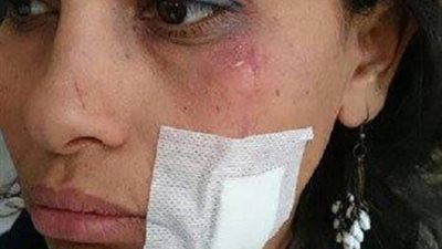 بالصور .. مديرمدرسة يضرب معلمة ويصيبها بجروح لرفضها إعطاء مجموعات