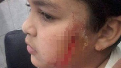 بالصور.. طالب ابتدائي يشوهه وجه زميلة بمطواه داخل مدرسة بالفيوم