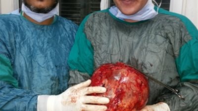 استئصال ورم يزن نحو 13 كيلو في عملية جراحية نادرة لمريض مسن بجامعة أسيوط
