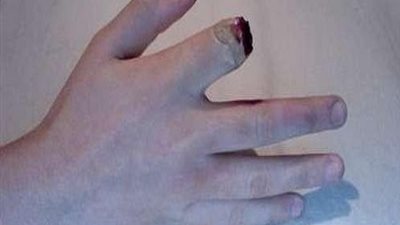 النيابة تأمر بسرعة ضبط ولي أمر قطع أصبع مدرس بالشرقية