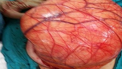 استئصال ورم يزن 10 كجم من بطن مريض بمستشفى الزهراء بجامعة الأزهر