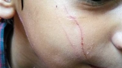 إصابة تلميذ بجرح قطعى فى الوجه بمدرسة خاصة بالزيتون 