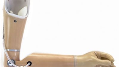 ضم الأطراف الصناعية العلوية لقائمة العلاج على نفقة الدولة