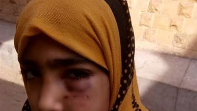 نتيجة للاهمال إصابة طالبة بتورم وكدمات فى العين بالشرقية