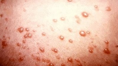 إصابة 29 تلميذا بالجديرى المائى بالسنطة.. ومنحهم إجازة 15 يوما