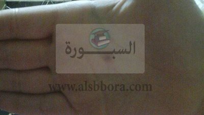 بالصور.. من أجل الدروس الخصوصية.. معلمة تحرق يد تلميذة فى إمبابة.. التلميذة تقى: الأبلة ولعت فى يدى بعود كبريت.. والد التلميذة يناشد الهلالى سرعة التدخل