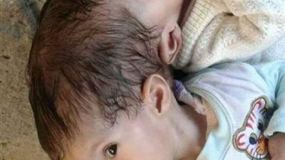 بالصور.. الملك سلمان يوجه بعلاج التوأم المصري ( منه ومي )